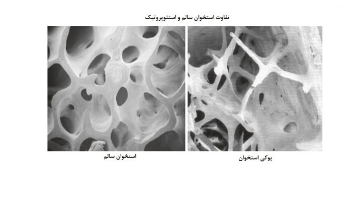 شکل3: تفاوت پوکی استخوان با استخوان سالم(تاثیر تمرین مقاومتی بر چگالی استخوان)